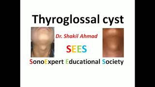 Thyroglossal Cyst [upl. by Lleneg471]