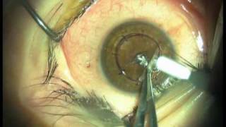 Deep Anterior Lamellar Keratoplasty DALK modified big bubble [upl. by Tnahsarp]