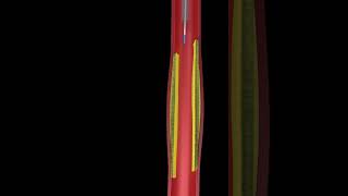 Animated angioplasty Explained in 3D  Watch the Procedure [upl. by Marola]