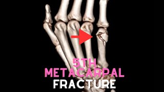 5th Metacarpal bone fracture [upl. by Are19]