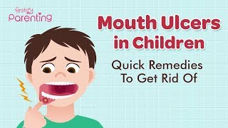 Mouth Ulcers Canker Sores in Children  Causes Symptoms amp Treatment [upl. by Denni]