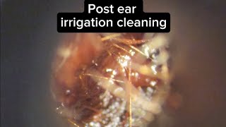 Earwax cleaning 20 post water irrigation [upl. by Richara232]