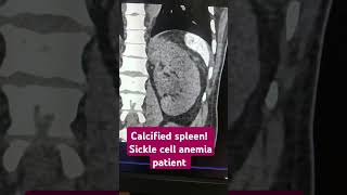 Calcified spleen Sickle cell anemia spleen anemia ctscan calcification radiology coreim [upl. by Cyndy]