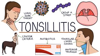 Understanding Tonsillitis [upl. by Karalynn]