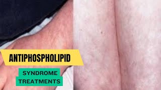 Antiphospholipid Syndrome Treatments [upl. by Leilah312]