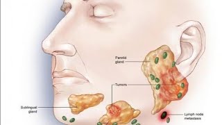 salivary gland tumors [upl. by Quirk]