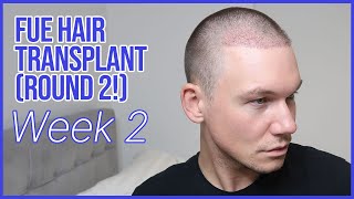 WEEK 2  FUE Hair Transplant Round 2  Removing Scabs and Losing Hair Shafts [upl. by Harutek]