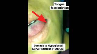 Tongue Fasciculation neet next [upl. by Nyrrat]