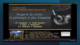 Imagerie du rocher  la pathologie la plus fréquente [upl. by Choo]