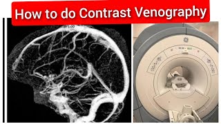 Contrast Venography MRI Scan Protocol Positioning amp Planning  Live Demo in English [upl. by Nosirb727]