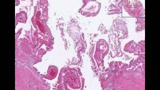 Histopathology GallbladderAcute cholecystitis [upl. by Harrell357]