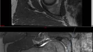 Hip MRI Approach to MSK MRI Series [upl. by Zinah]