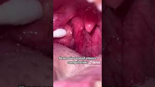 tonsil stones compilation [upl. by Enelyt264]