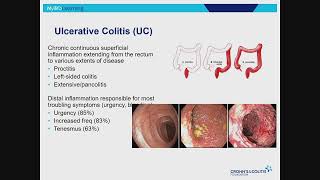 IBD 101 An Overview of Inflammatory Bowel Disease [upl. by Iznik881]