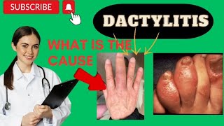 Dactylitis or sausage finger [upl. by Seeto]