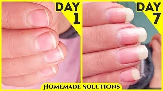 नाखूनों को तेज़ी से लम्बे मजबूत और सुंदर बनाने के सबसे असरदार उपाय  How to grow your nails fast [upl. by Erialc448]