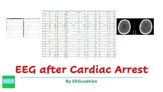 EEG After Anoxic Brain Injury [upl. by Drageruaeb]