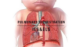 Pulmonary sequestration notes [upl. by Sherilyn219]