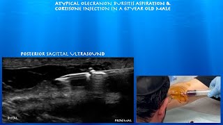 Ultrasound Guided Atypical Olecranon Bursitis Aspiration and Cortisone Injection by probeultrasound [upl. by Cesar451]