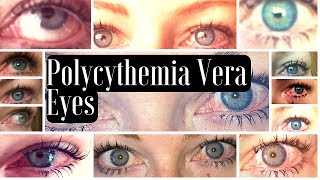 MPN Polycythemia Vera Blood Shot Red Eye Manifestations [upl. by Oniratac]