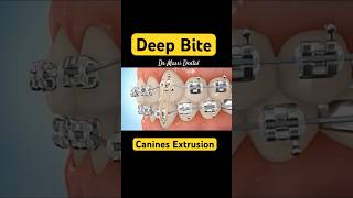 CANINE EXTRUSION Braces  Orthodontics treatments [upl. by Atenahs]