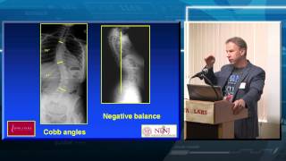 Spinal Deformity Overview [upl. by Ttevi118]