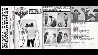 Hydrocephalus  Split Tape With Flyblown Foetus [upl. by Aivlis]