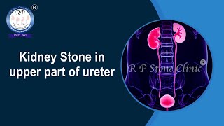 Kidney Stone in upper ureter Animation  Kidney Stone [upl. by Evonne269]