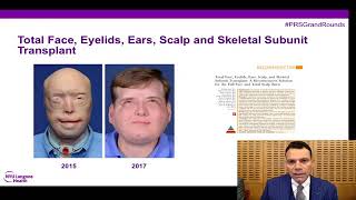 PRSGrandRounds Face Transplantation  Current State amp Future Directions [upl. by Greer882]