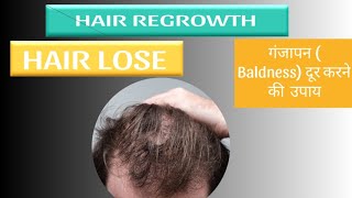 minoxidil hair regrowth results  best minoxidil ebadurhaircaretips [upl. by Llednohs501]