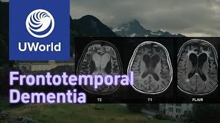 Frontotemporal Dementia vs Alzheimer Disease with Histology  UWorld USMLE MBBS [upl. by Fredi]