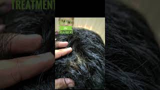 Case of Alopecia areata cure with homoeopathic medicine homoeopathy holistichealth india [upl. by Nnaylloh]