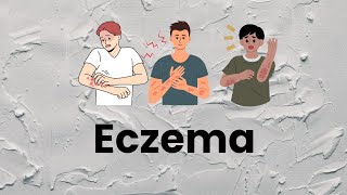 Eczema causes and treatment explained in Hindi [upl. by Ybrad]