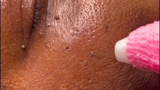 Amazing before and after DPN Dermatosis Papulosa Nigra Removal [upl. by Rimisac894]