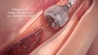 Thrombectomy  Treating blocked veins by therapeutic medical device [upl. by Ttessil]