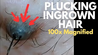 See How Ingrown Hair Gets Plucked at 100x Magnified Thick black hair with long wet amp slimy root [upl. by Zingale66]