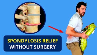 Spondylosis Treatment Without Surgery 🔥 Spondylolisthesis Causes [upl. by Cash800]