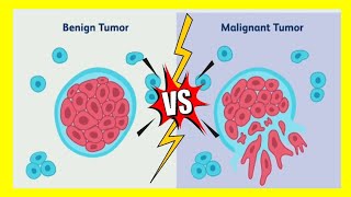 Difference between Benign and Malignant Tumor [upl. by Bora]