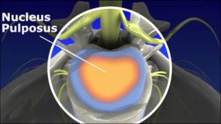 Herniated Disc  Pain Management [upl. by Akimet]