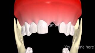 Mental protuberance graft Clinic Package [upl. by Nemaj]