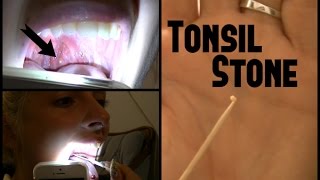 Tonsil Stone REMOVAL [upl. by Sidnarb]