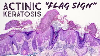 Hypertrophic Actinic Keratosis with perfect quotflag signquot dermatology pathology dermatopathology [upl. by Rexanne]