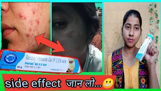 Benzoyl Peroxide Gel 25 Review In Hindi  Uses And Side Effect  miss glossy girl [upl. by Bram9]