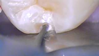 Boca Raton Cosmetic Dentistry Conservative Tooth Colored Resin Filling 1  Preparation [upl. by Leizo]