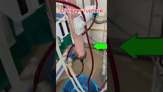 Dialyzer rupture hemodialysis ckdpatient hospital [upl. by Ecirtak]