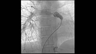 Single Pulmonary artery  cardiology medicine ACHD [upl. by Donella]