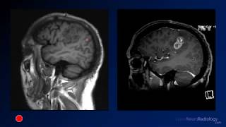 Neuroradiology board review 3 case 10 [upl. by Adaha]