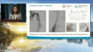 Emergency Treatment As Aortic Rupture From Chronic TBAD Using The Candy Plug Technique [upl. by Craner156]