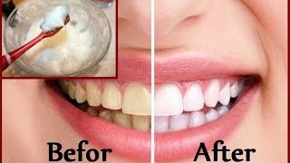 DIY Teeth Whitening at Home in 2 minutes [upl. by Madea]