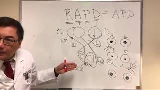 RAPD Relative Afferent Pupillary Defect MarcusGunn pupil [upl. by Eibot]